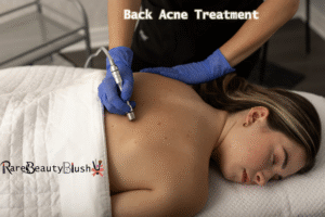 Back Acne Treatment Causes, Care, and Clear Skin Solutions