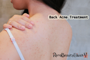 Back Acne Treatment Causes, Care, and Clear Skin Solutions