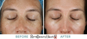 Chemical Peel Before and After What to Expect for Glowing Skin