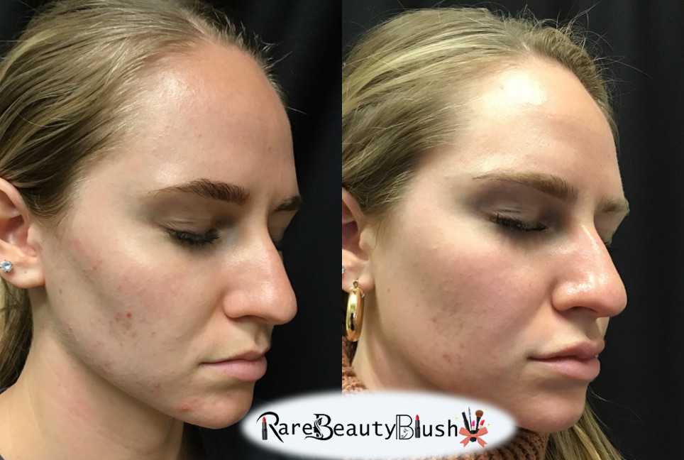 Chemical Peel Before and After What to Expect for Glowing Skin