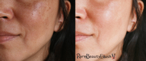 Chemical Peel Before and After What to Expect for Glowing Skin